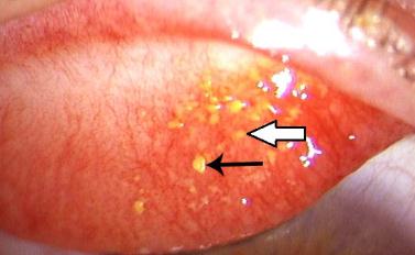 眼表眼角膜,?，斎鹨曆劭?上海眼科醫(yī)院