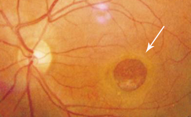 玻璃體視網(wǎng)膜,希瑪瑞視眼科,上海眼科醫(yī)院 玻璃體視網(wǎng)膜,希瑪瑞視眼科,上海眼科醫(yī)院