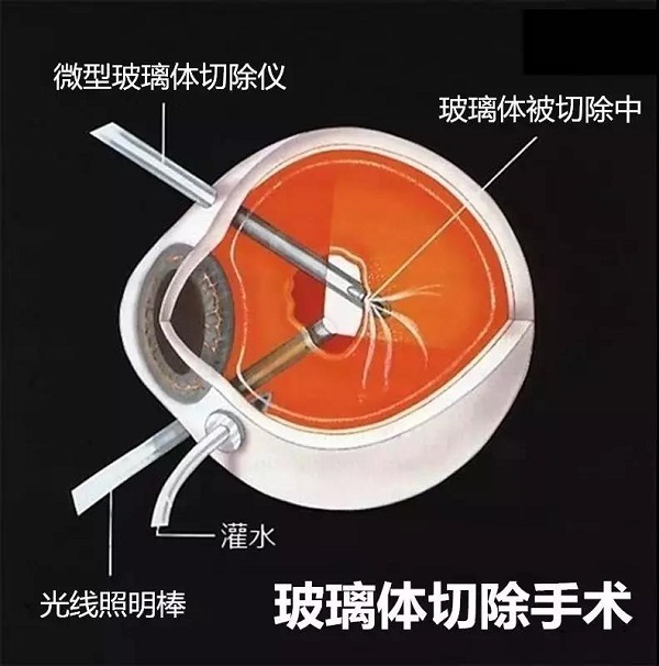 玻璃體視網膜,希瑪瑞視眼科,上海眼科醫(yī)院 玻璃體視網膜,希瑪瑞視眼科,上海眼科醫(yī)院