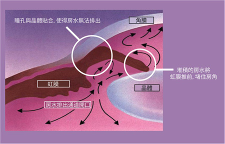 青光眼,希瑪瑞視眼科,上海眼科醫(yī)院