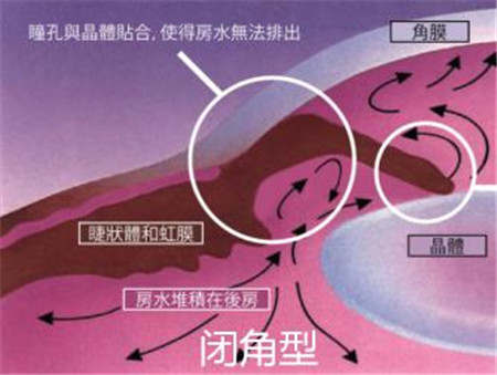 青光眼,希瑪瑞視眼科,上海眼科醫(yī)院