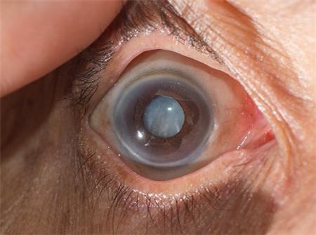 白內障,希瑪瑞視眼科,上海眼科醫院 白內障,希瑪瑞視眼科,上海眼科醫院