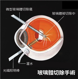 玻璃體視網膜,?，斎鹨曆劭?上海眼科醫院