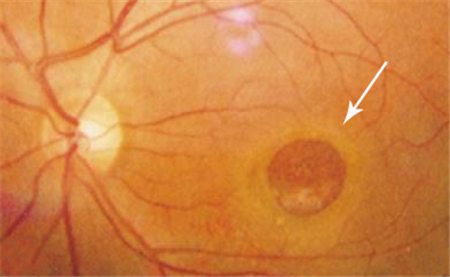 玻璃體視網膜,?，斎鹨曆劭?上海眼科醫院