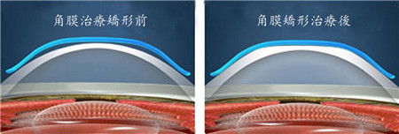 屈光矯視,希瑪瑞視眼科,上海眼科醫院 屈光矯視,希瑪瑞視眼科,上海眼科醫院