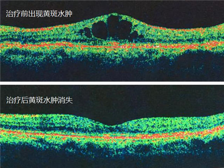 玻璃體視網膜,希瑪瑞視眼科,上海眼科醫院