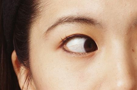 小兒眼病,希瑪瑞視眼科,上海眼科醫(yī)院