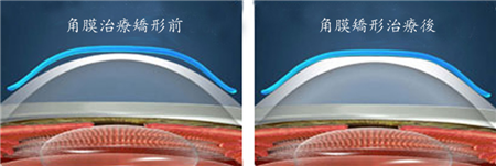 屈光矯視,希瑪瑞視眼科,上海眼科醫院 屈光矯視,希瑪瑞視眼科,上海眼科醫院