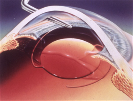 白內障,希瑪瑞視眼科,上海眼科醫院