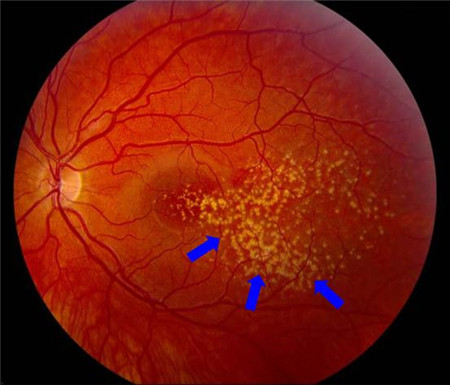 玻璃體視網膜,希瑪瑞視眼科,上海眼科醫院