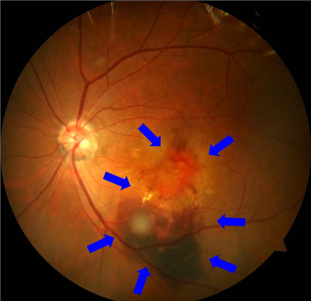 玻璃體視網膜,希瑪瑞視眼科,上海眼科醫院