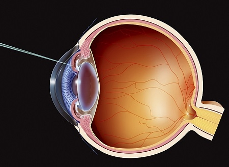 青光眼,希瑪瑞視眼科,上海眼科醫院