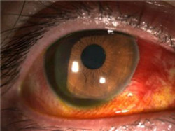 眼表眼角膜,希瑪瑞視眼科,上海眼科醫院