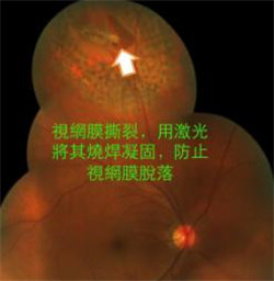 玻璃體視網(wǎng)膜,希瑪瑞視眼科,上海眼科醫(yī)院 玻璃體視網(wǎng)膜,希瑪瑞視眼科,上海眼科醫(yī)院