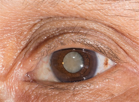 白內障,?，斎鹨曆劭?上海眼科醫院