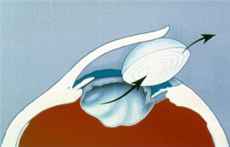 白內障,?，斎鹨曆劭?上海眼科醫院