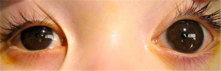 青光眼,?，斎鹨曆劭?上海眼科醫(yī)院