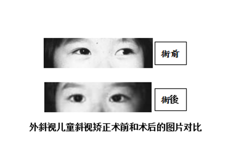 小兒眼病,希瑪瑞視眼科,上海眼科醫院