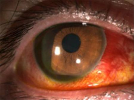 玻璃體視網(wǎng)膜,?，斎鹨曆劭?上海眼科醫(yī)院