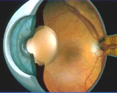 白內障,希瑪瑞視眼科,上海眼科醫院