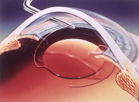 白內障,?，斎鹨曆劭?上海眼科醫院