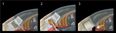 青光眼,希瑪瑞視眼科,上海眼科醫院