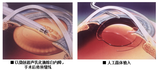 白內(nèi)障,希瑪瑞視眼科,上海眼科醫(yī)院 白內(nèi)障,希瑪瑞視眼科,上海眼科醫(yī)院