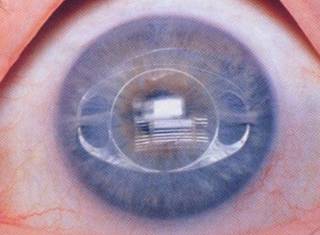 屈光矯視,希瑪瑞視眼科,上海眼科醫院