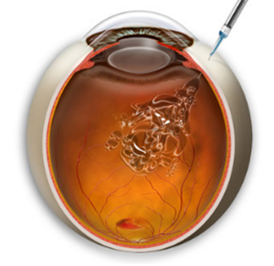 玻璃體視網(wǎng)膜,希瑪瑞視眼科,上海眼科醫(yī)院 玻璃體視網(wǎng)膜,希瑪瑞視眼科,上海眼科醫(yī)院