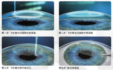 屈光矯視,希瑪瑞視眼科,上海眼科醫(yī)院