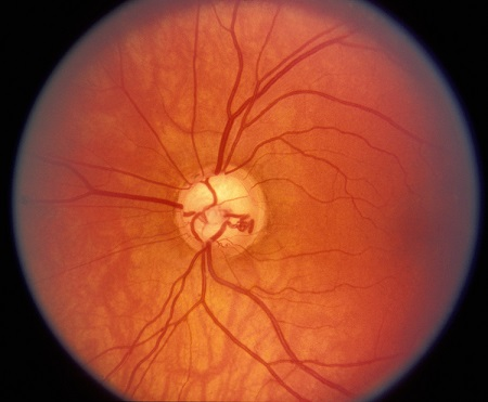 青光眼,希瑪瑞視眼科,上海眼科醫(yī)院