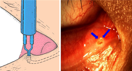 眼表眼角膜,希瑪瑞視眼科,上海眼科醫院 眼表眼角膜,希瑪瑞視眼科,上海眼科醫院