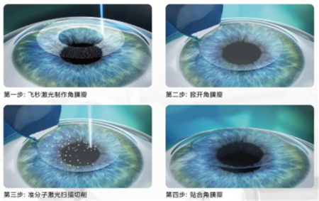 屈光矯視,希瑪瑞視眼科,上海眼科醫院 屈光矯視,希瑪瑞視眼科,上海眼科醫院