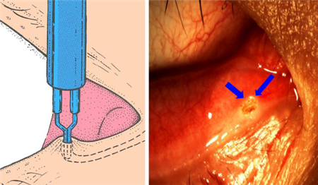 眼表眼角膜,?，斎鹨曆劭?上海眼科醫院