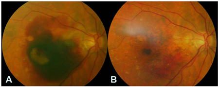 玻璃體視網膜,希瑪瑞視眼科,上海眼科醫院 玻璃體視網膜,希瑪瑞視眼科,上海眼科醫院
