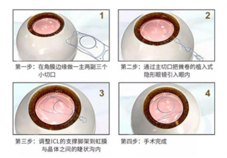 屈光矯視,希瑪瑞視眼科,上海眼科醫院 屈光矯視,希瑪瑞視眼科,上海眼科醫院