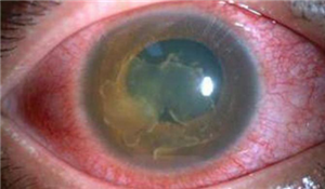 眼表眼角膜,希瑪瑞視眼科,上海眼科醫(yī)院 眼表眼角膜,希瑪瑞視眼科,上海眼科醫(yī)院