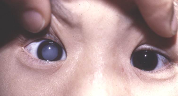 白內障,希瑪瑞視眼科,上海眼科醫院 白內障,希瑪瑞視眼科,上海眼科醫院