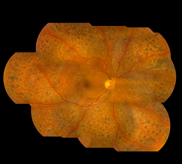 玻璃體視網(wǎng)膜,希瑪瑞視眼科,上海眼科醫(yī)院 玻璃體視網(wǎng)膜,希瑪瑞視眼科,上海眼科醫(yī)院