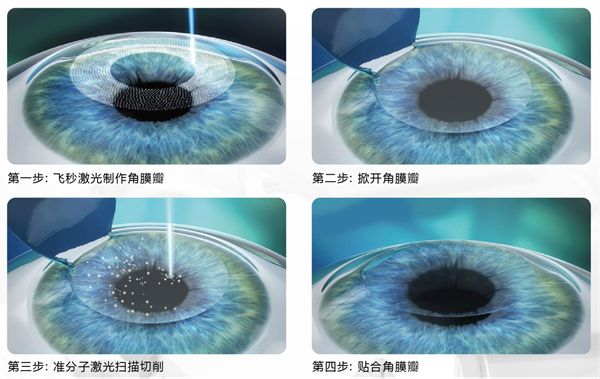 屈光矯視,希瑪瑞視眼科,上海眼科醫院