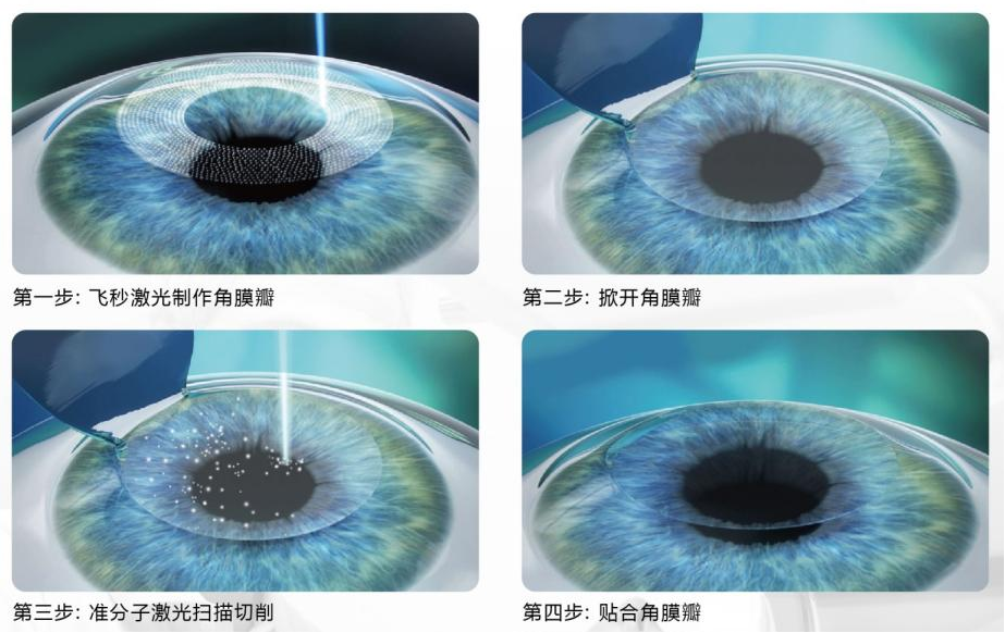 屈光矯視,希瑪瑞視眼科,上海眼科醫院