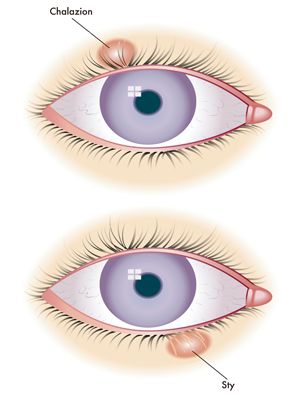 眼表眼角膜,希瑪瑞視眼科,上海眼科醫院 眼表眼角膜,希瑪瑞視眼科,上海眼科醫院