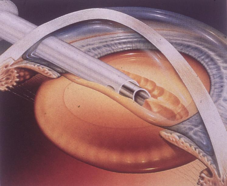 白內障,希瑪瑞視眼科,上海眼科醫院 白內障,希瑪瑞視眼科,上海眼科醫院