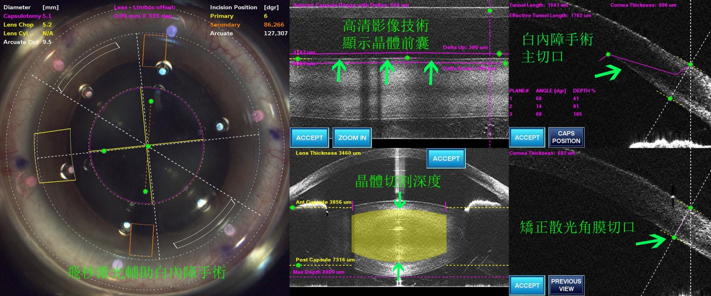 白內障,希瑪瑞視眼科,上海眼科醫院 白內障,希瑪瑞視眼科,上海眼科醫院