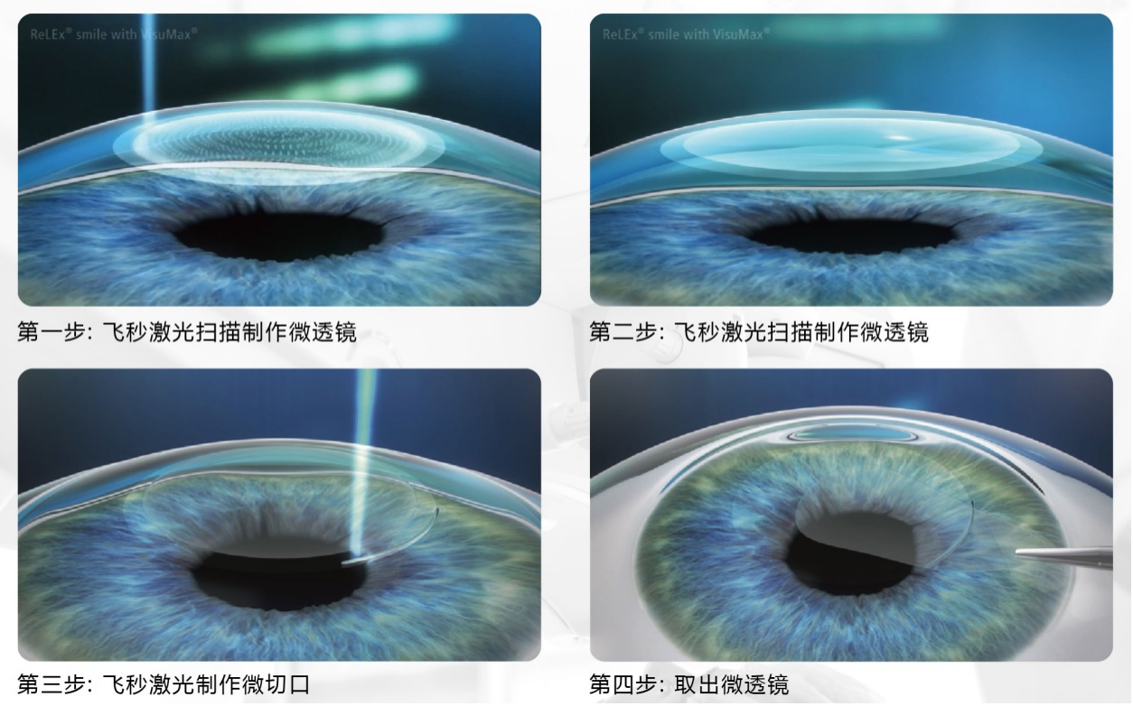 屈光矯視,希瑪瑞視眼科,上海眼科醫(yī)院 屈光矯視,希瑪瑞視眼科,上海眼科醫(yī)院