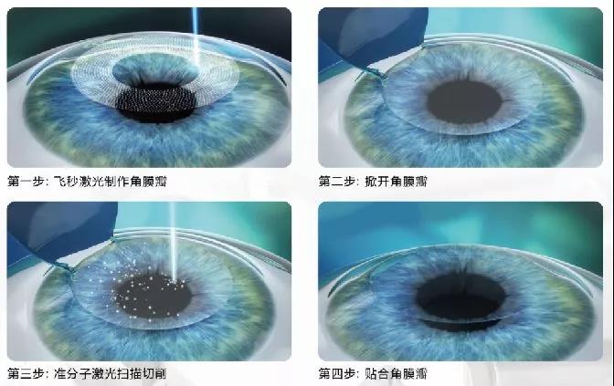 屈光矯視,?，斎鹨曆劭?上海眼科醫院