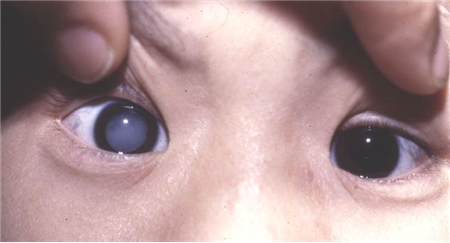 白內障,希瑪瑞視眼科,上海眼科醫院 白內障,希瑪瑞視眼科,上海眼科醫院